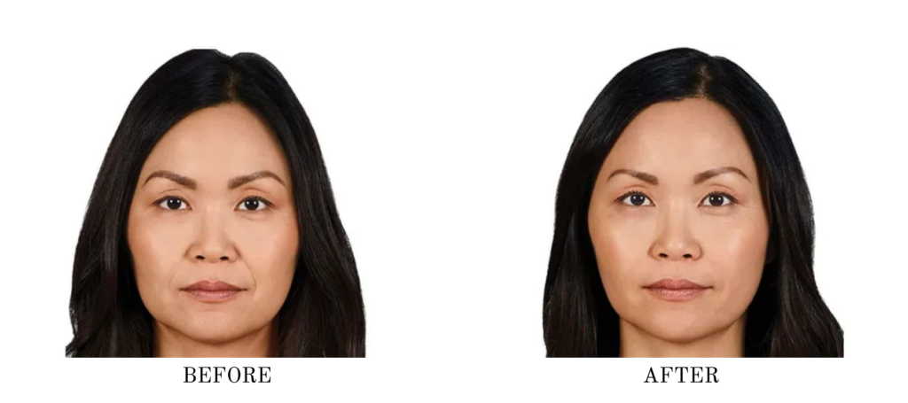 Before & After Juvederm Ultra Plus