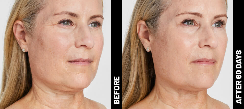 Before & After Ultherapy