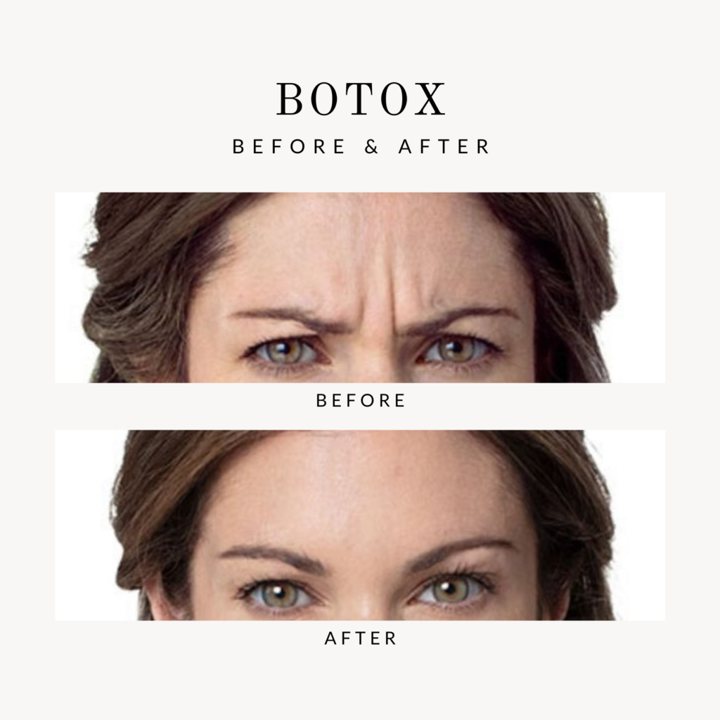 Before & After Botox