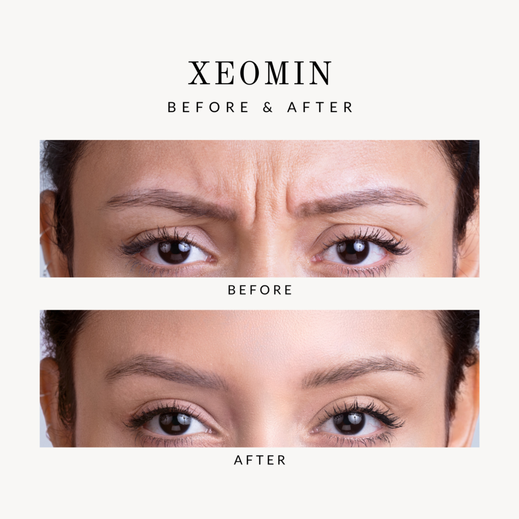 Before & After Xeomin