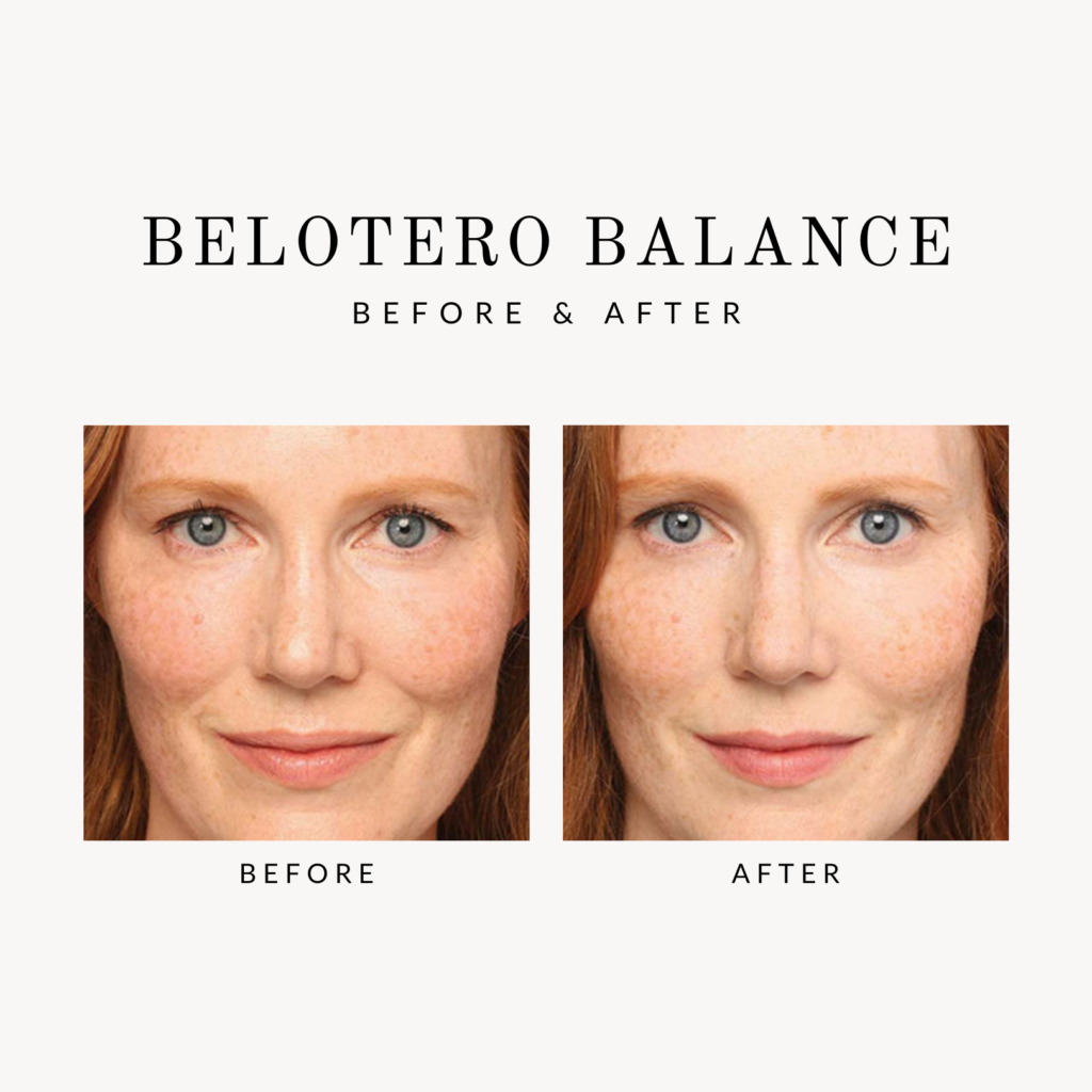 Before & After Belotero Balance